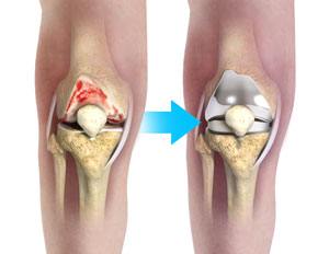 knee joint replacement devices