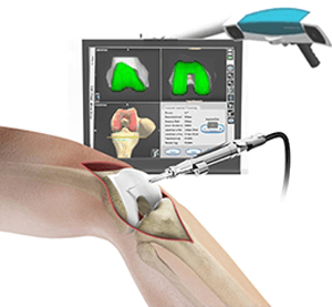 Computer Navigation for Total Knee Replacement