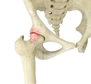 Femoroacetabular Impingement