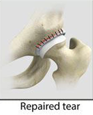 Hip Labral Repair