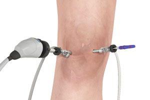 Unicompartmental/Partial Knee Replacement