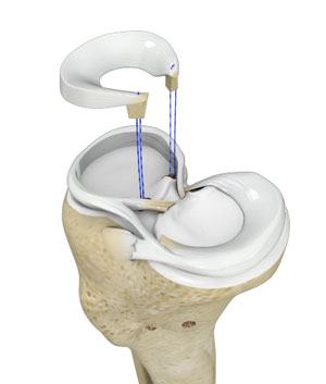 Meniscal Surgery