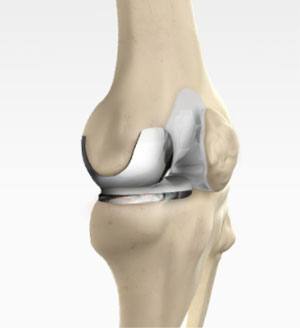 Unicompartmental/Partial Knee Replacement