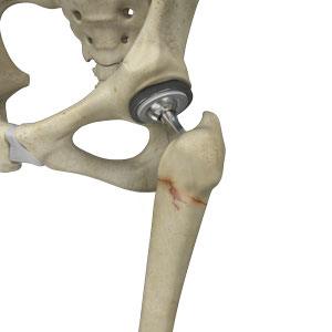 Periprosthetic Hip Fractures