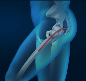 Posterior Hip Replacement