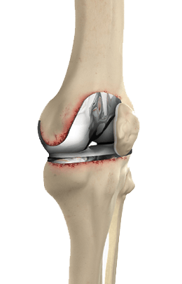 Revision Knee Replacement