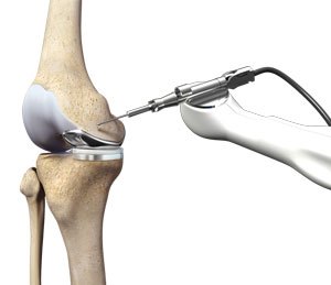Mako Robotic-Arm Assisted Technology for Total Knee Replacement