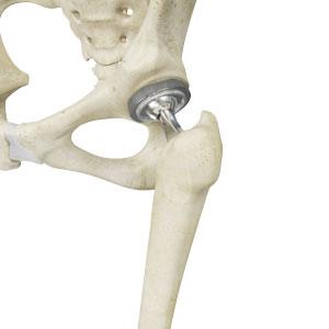 Total Hip Replacement